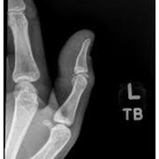 X-Ray Right Thumb LAT View